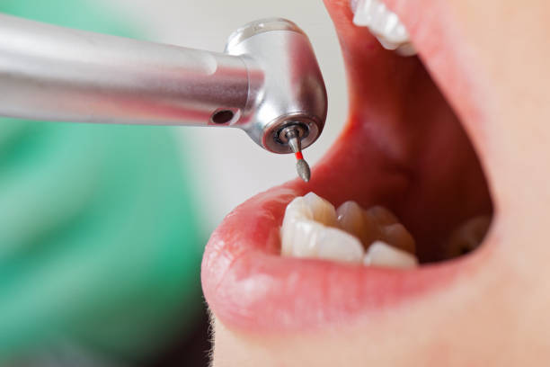 Best Urgent Tooth Repair  in Coing, AL